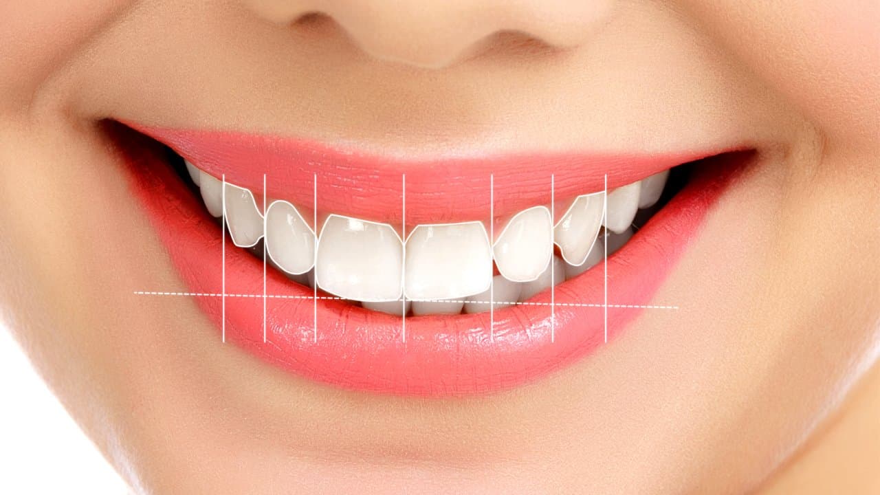 Ankarada Gülüş Tasarımı Estetik ve Fonksiyon Bir Arada