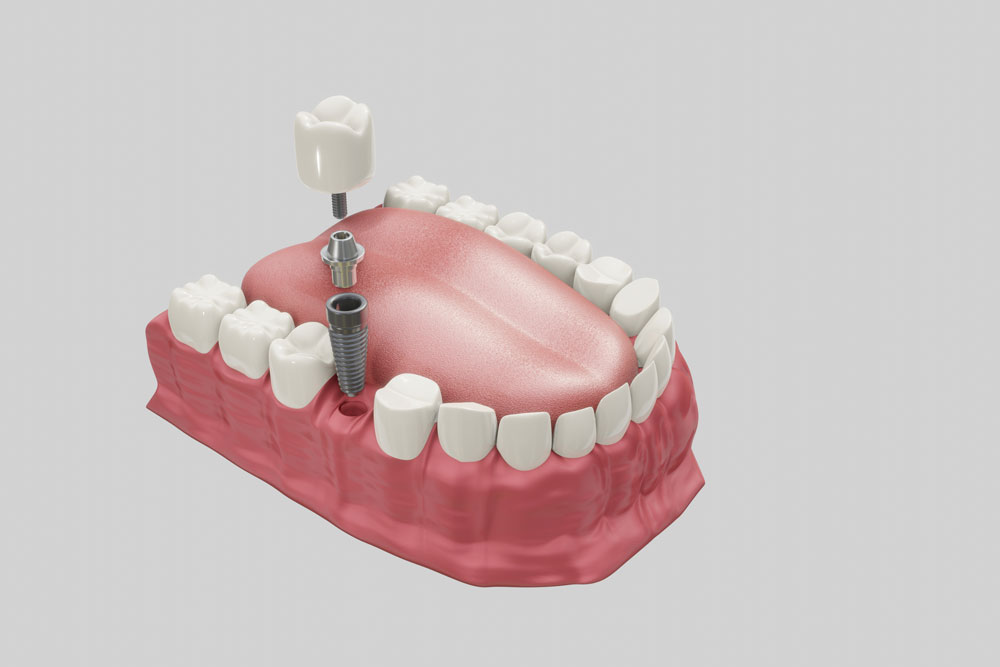 implant